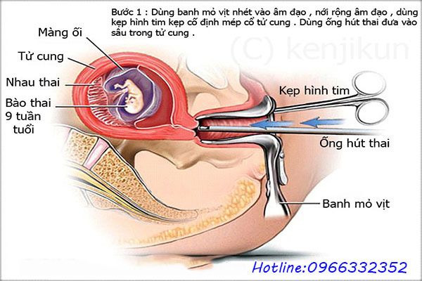 Hút thai an toàn