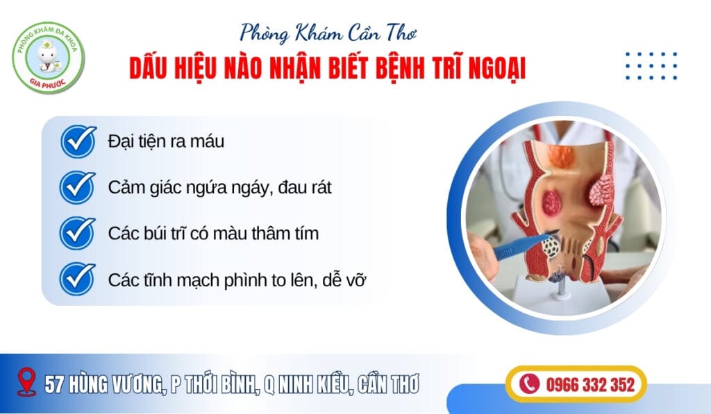 Dấu hiệu nào nhận biết bệnh trĩ ngoại (1)