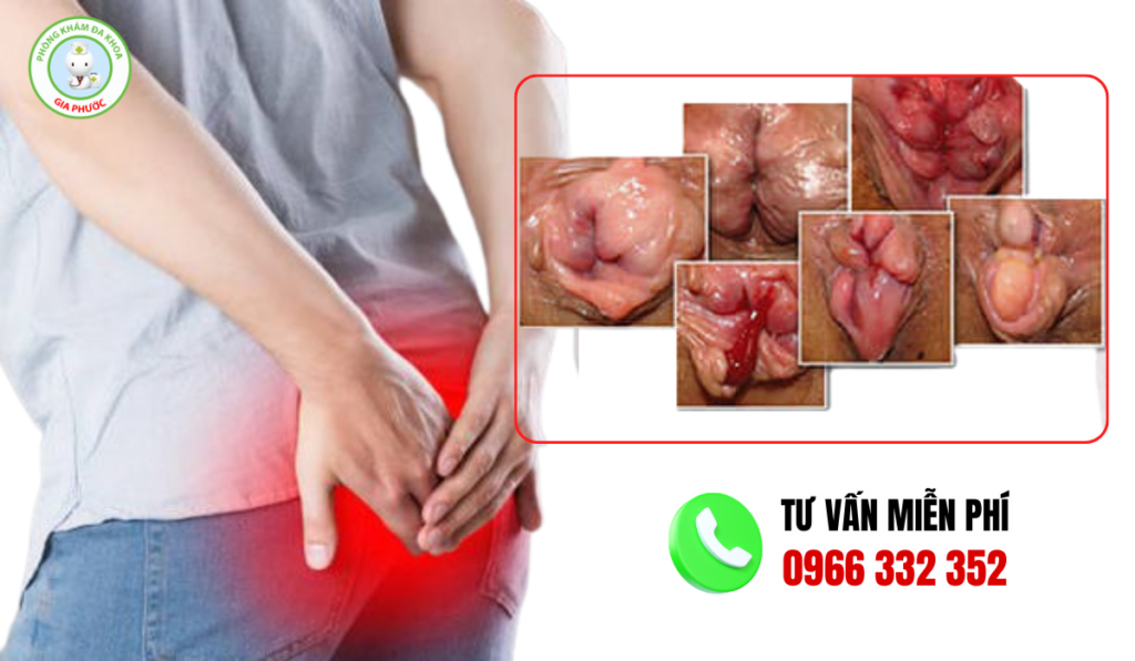 Hình ảnh trĩ hỗn hợp