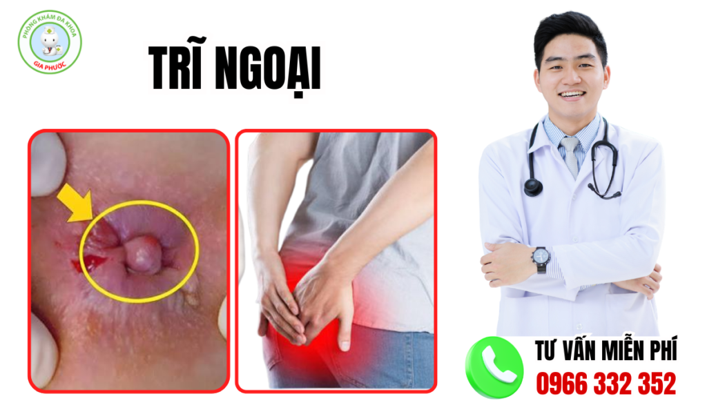 Hình ảnh trĩ ngoại giai đoạn nặng