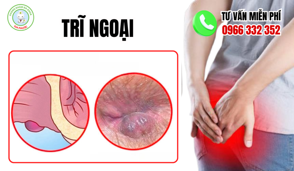 Hình ảnh trĩ ngoại giai đoạn nhẹ