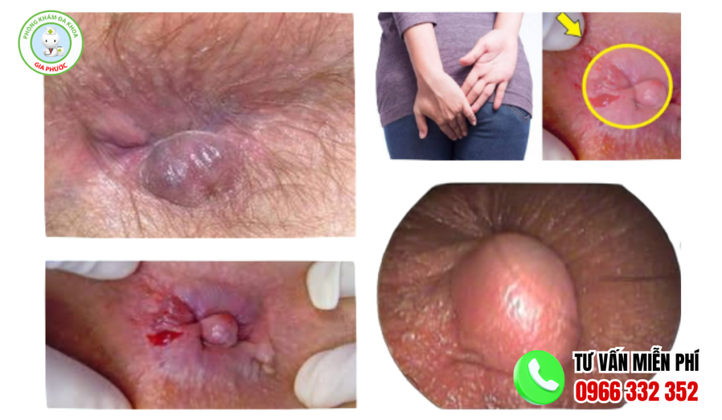 Hình ảnh trĩ nội độ 1 và độ 2