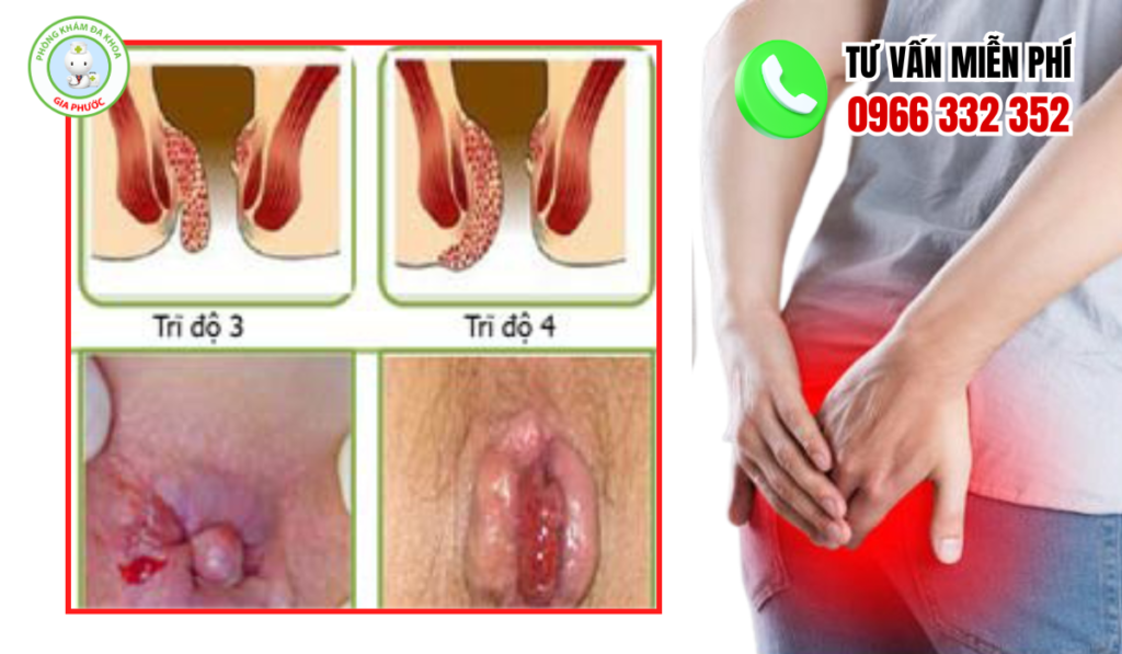 Hình ảnh trĩ nội độ 3 và độ 4