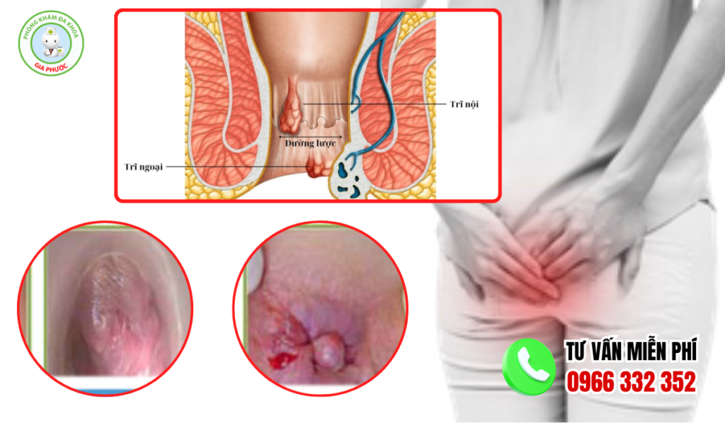 Hình ảnh trĩ nội. trĩ ngoại và trĩ hỗn hợp