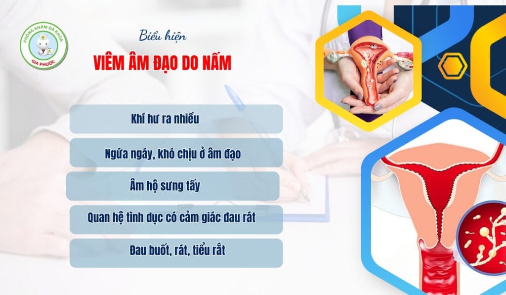 Biểu hiện viêm âm đạo do nấm