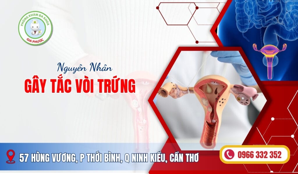 Nguyên nhân gây tắc vòi trứng 1