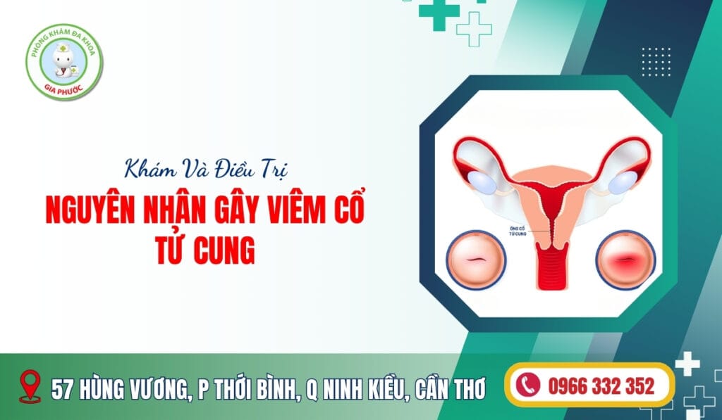Nguyên Nhân Gây Viêm Cổ Tử Cung