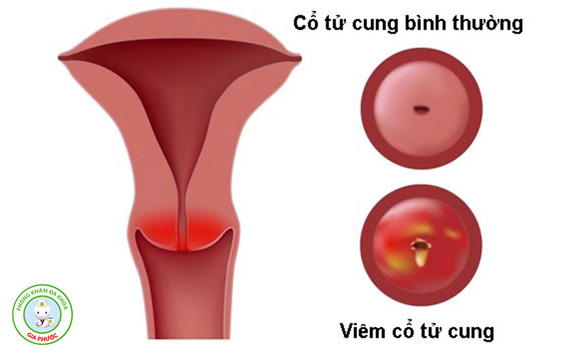 Hiện nay có rất nhiều chị em phụ nữ mắc phải viêm cổ tử cung