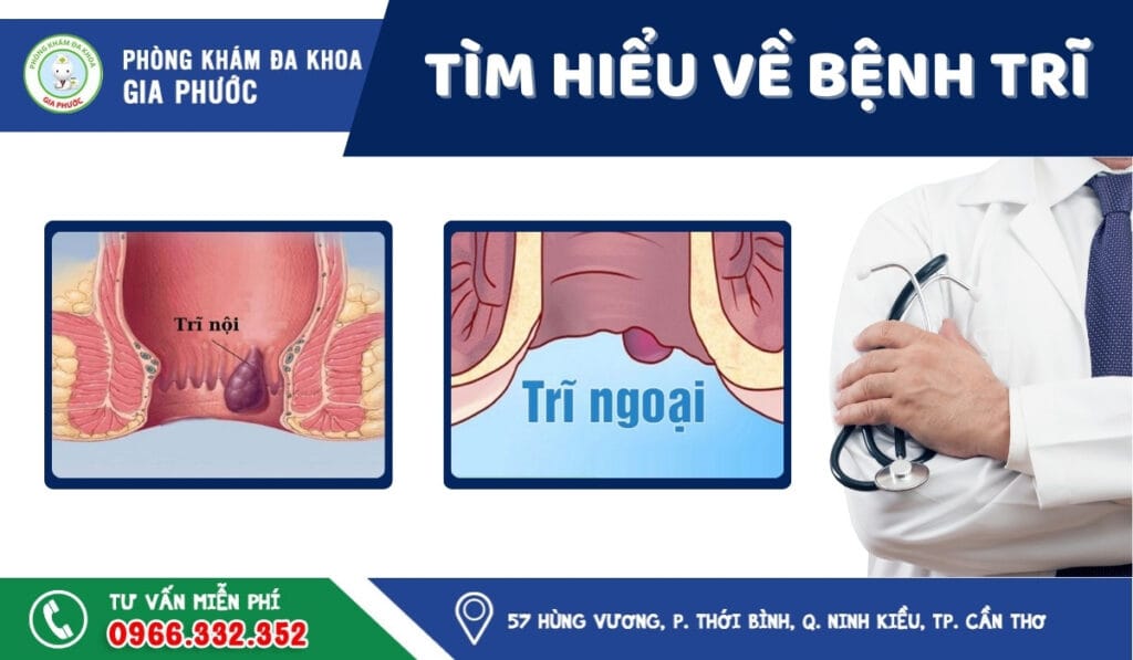 Trị bệnh trĩ ở cần thơ