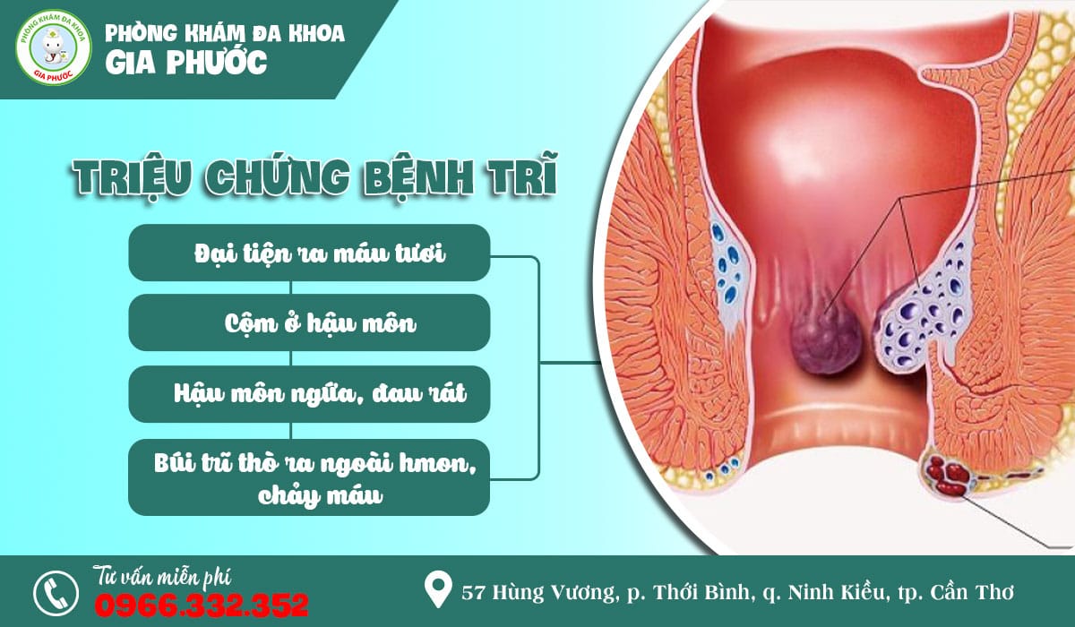 Triệu chứng bệnh trĩ