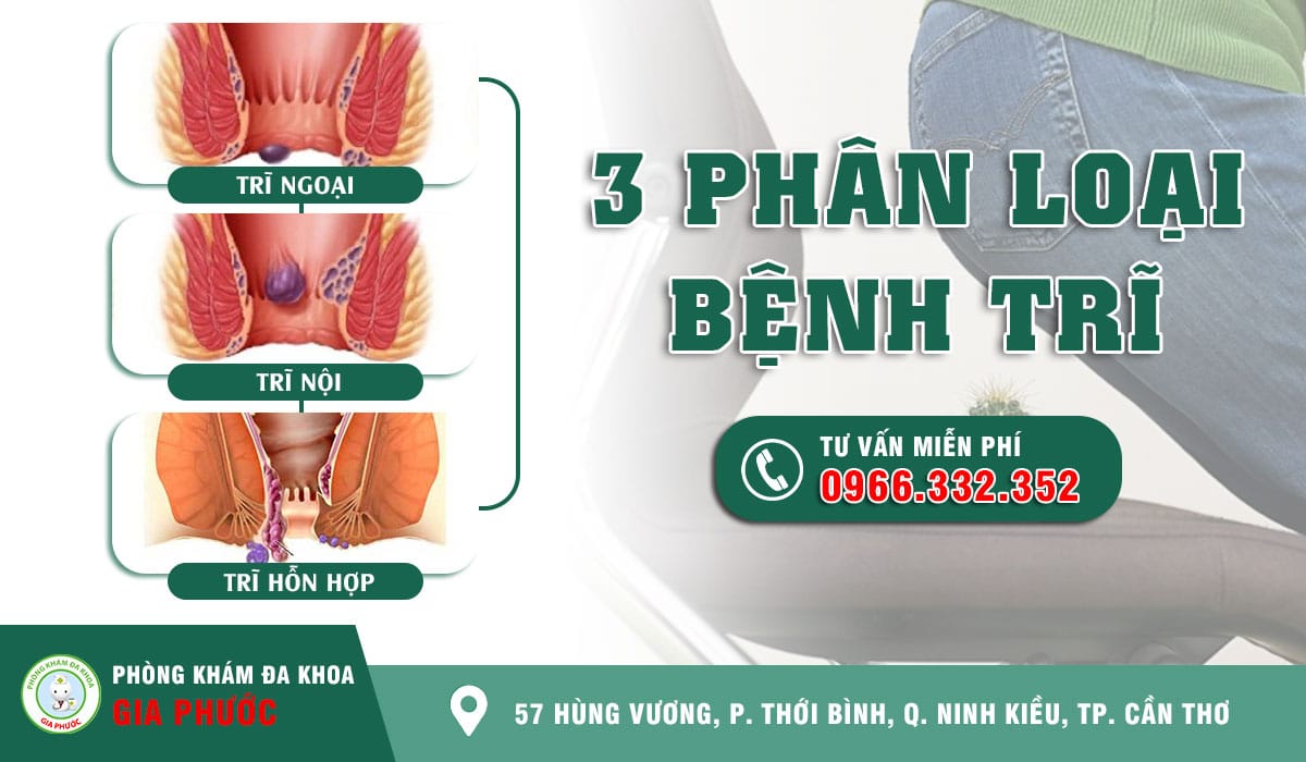 Phân biệt trĩ nội, trĩ ngoại và trĩ hỗn hợp dựa vào vị trí mọc trĩ