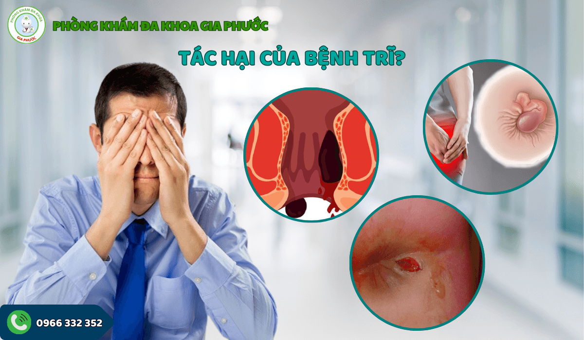 Tác hại của bệnh trĩ? Mức độ nguy hiểm nếu không điều trị kịp thời?