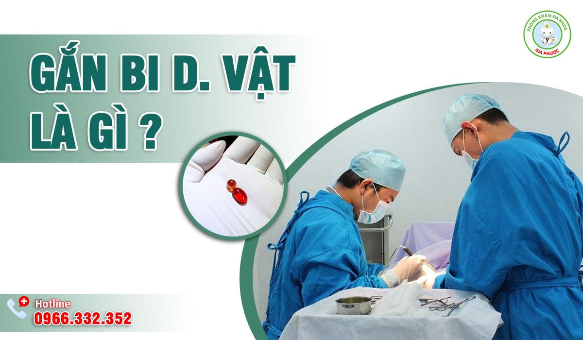 Gắn bi dương vật là gì