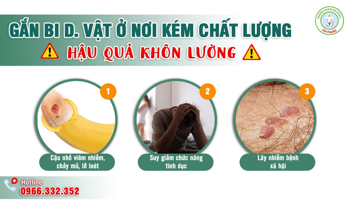 Hậu quả khi gắn bi dương vật ở cơ sở y tế kém chất lượng