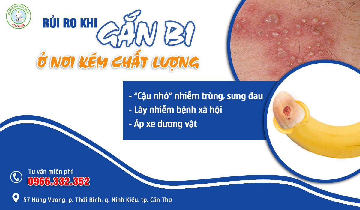 Rủi ro khi gắn bi dương vật ở những nơi kém chất lượng