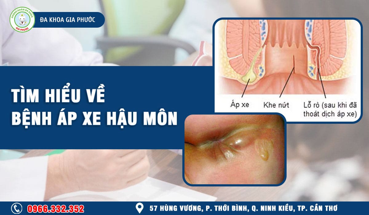Tìm hiểu về bệnh áp xe hậu môn là gì