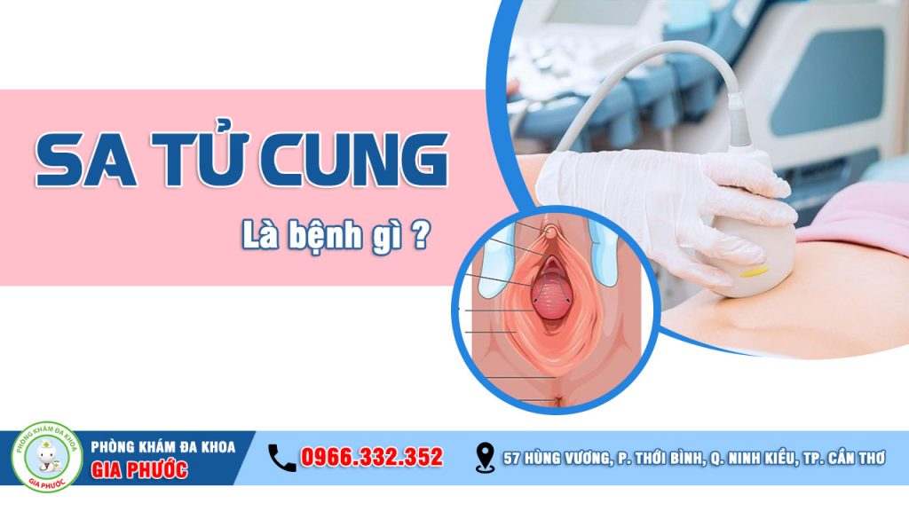 Bệnh sa tử cung là gì?