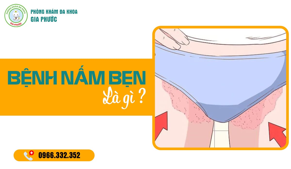 Bệnh nấm bẹn là bệnh gì?
