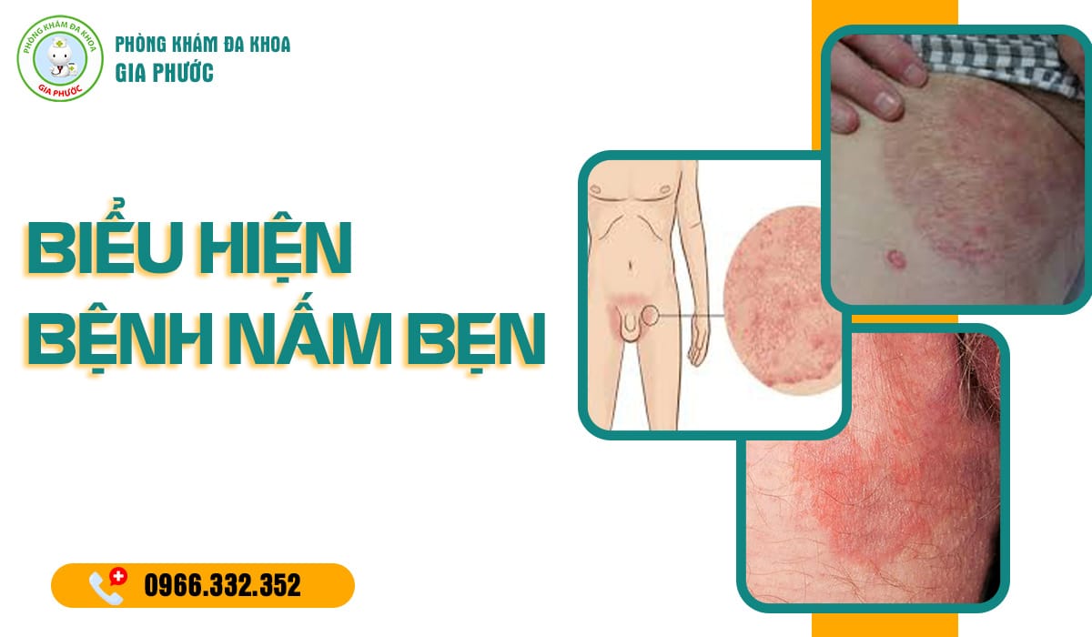 Biểu hiện bệnh nấm bẹn ở nam giới