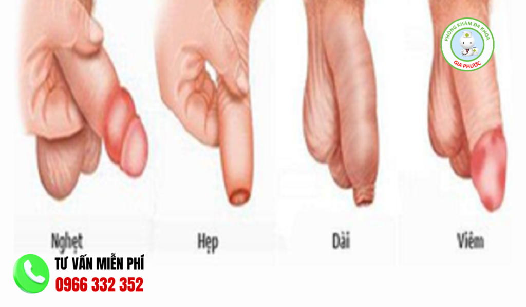 Tổng hình ảnh dương vật bất thường