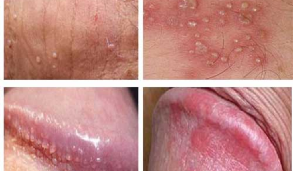 Hình ảnh bị nấm ở vùng kín nam