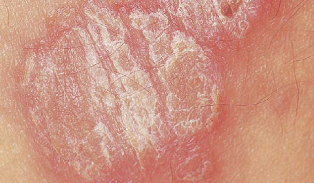 Hình ảnh bị nấm ở vùng kín nam