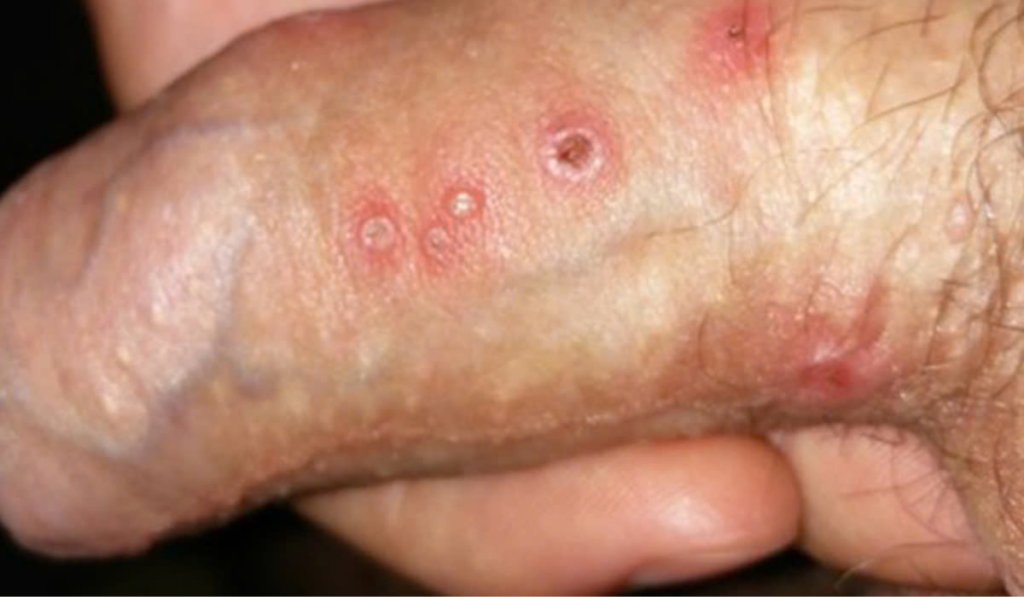 Hình ảnh bị nấm ở vùng kín nam