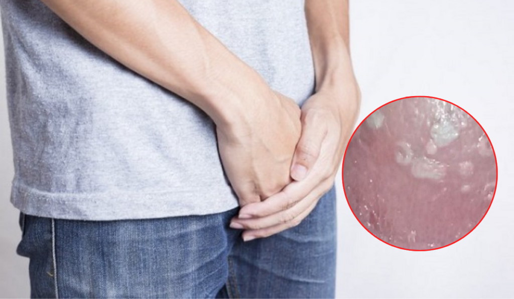 Hình ảnh bị nấm ở vùng kín nam