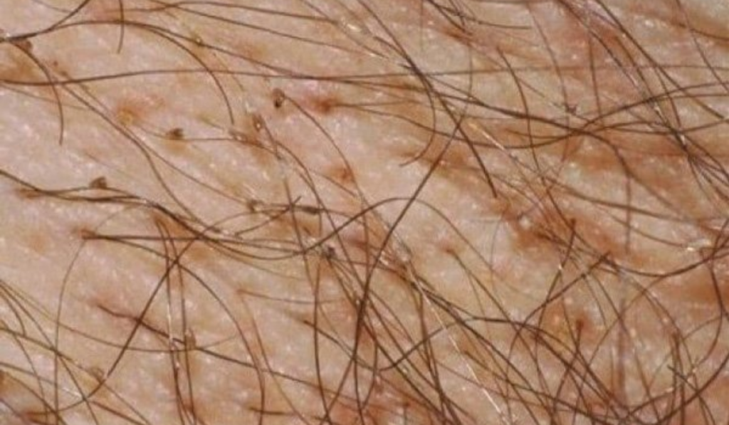 Hình ảnh bị nấm ở vùng kín nam