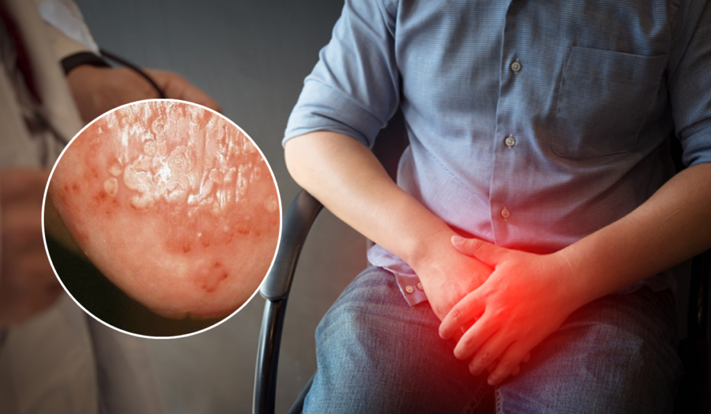 Hình ảnh bị nấm ở vùng kín nam