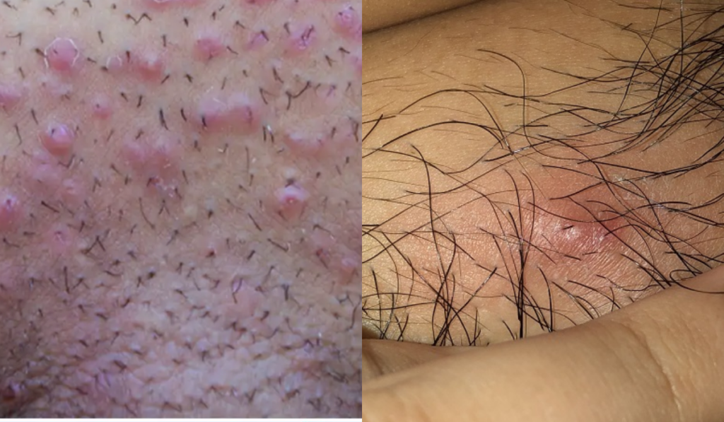 Hình ảnh bị nấm ở vùng kín nam