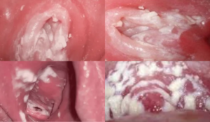 Hình ảnh bị nấm vùng kín