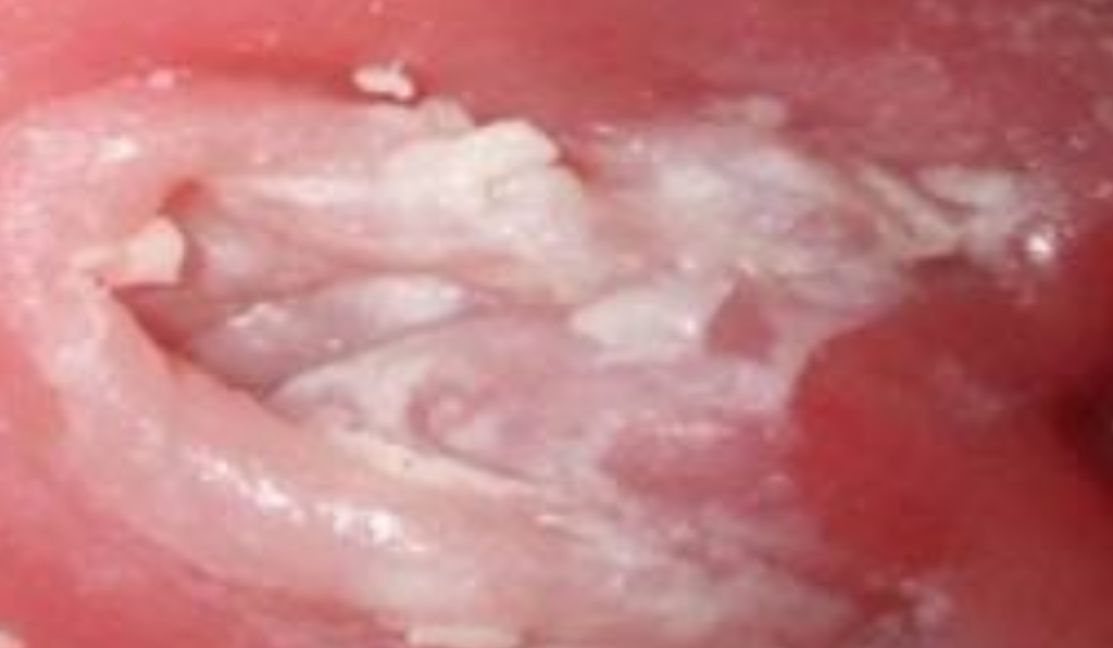 Hình ảnh bị nấm vùng kín