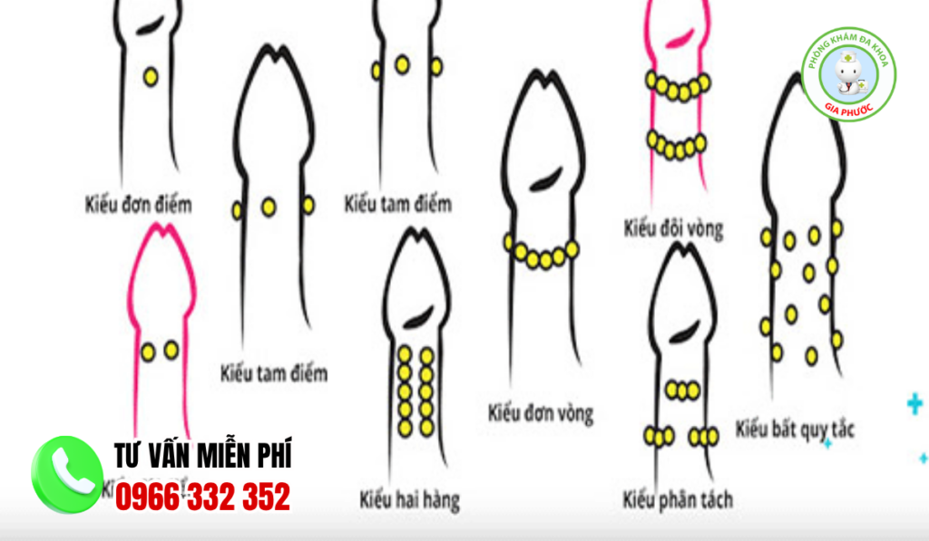 Hình ảnh gắn bi cho nam giới chuẩn y khoa