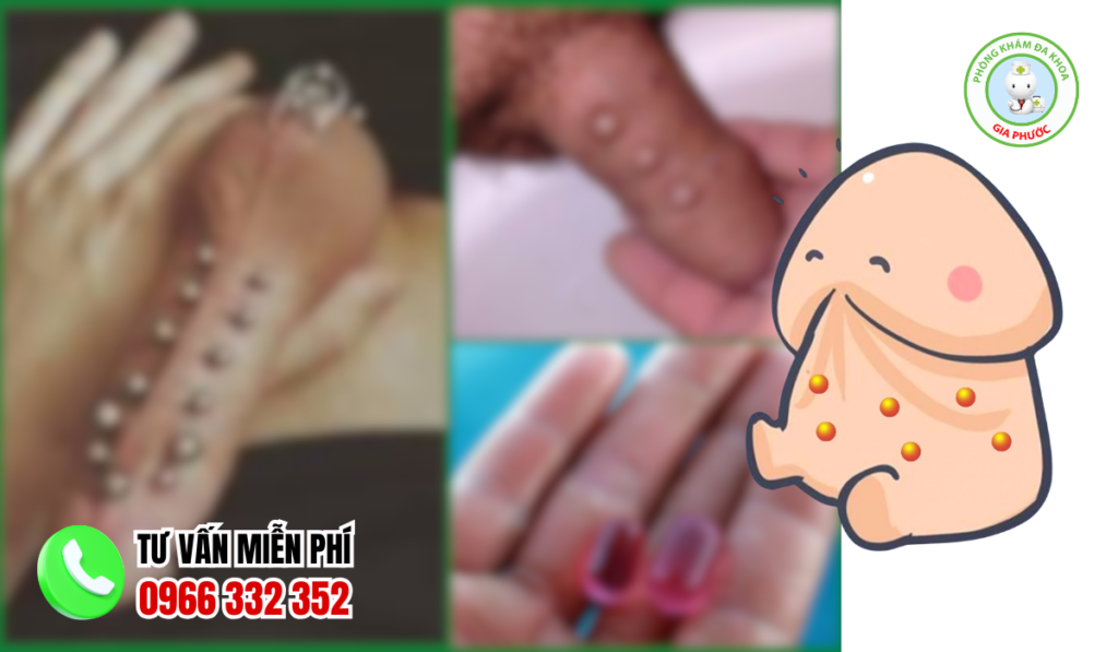 Hình ảnh gắn bi cho nam giới chuẩn y khoa