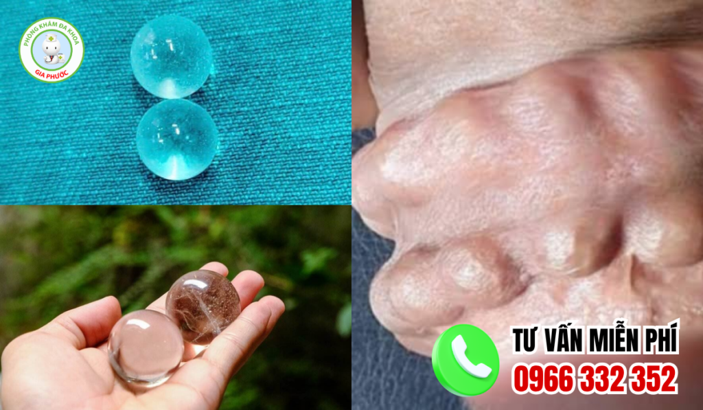 Hình ảnh gắn bi vào của quý nam giới