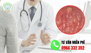 Cách chữa gai sinh dục nữ tại nhà