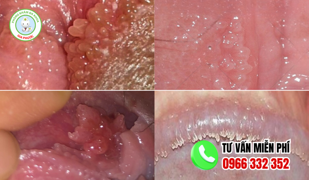 Hình ảnh mụn gai sinh dục nữ