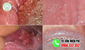 Hình ảnh mụn gai sinh dục nữ