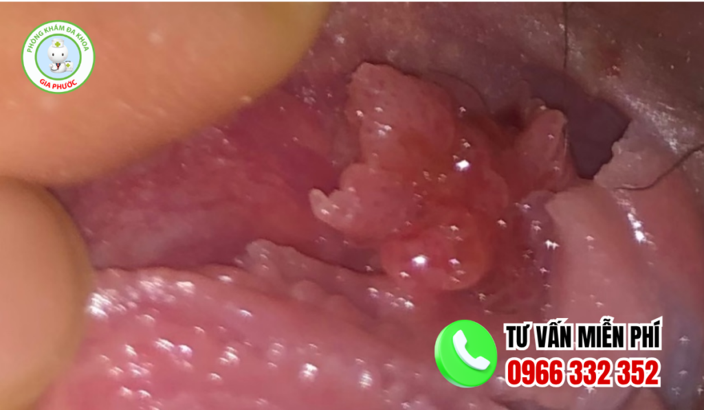 Hình ảnh mụn gai sinh dục nữ