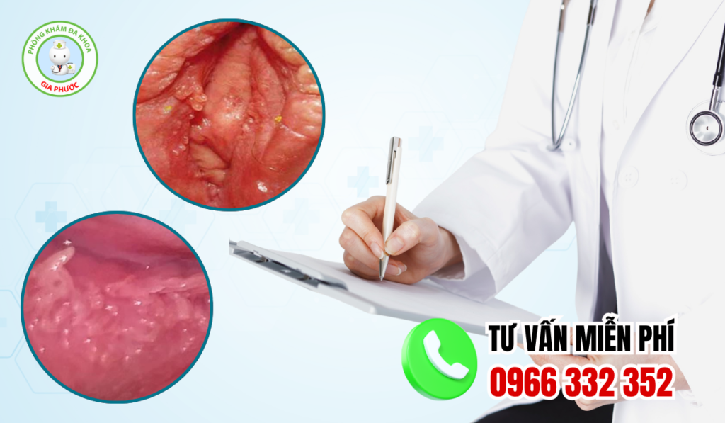 Hình ảnh mụn gai sinh dục nữ 