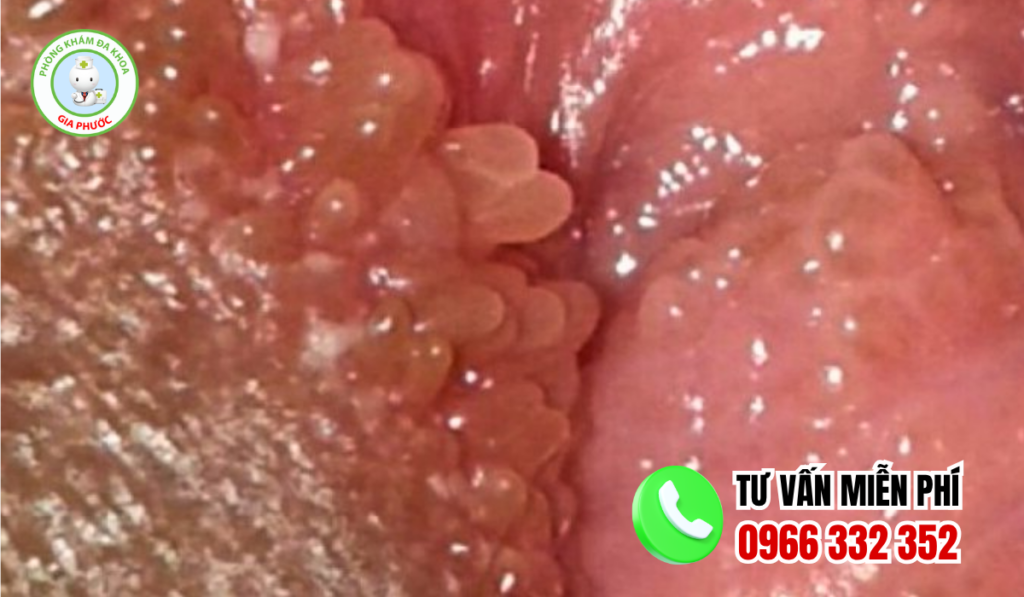 Hình ảnh mụn gai sinh dục nữ