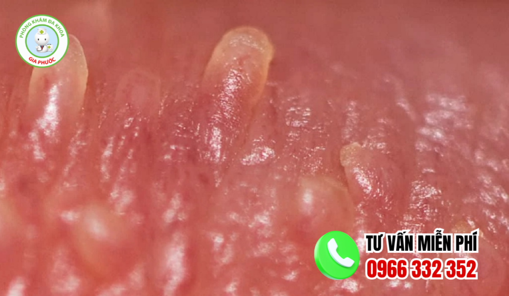 Hình ảnh mụn gai sinh dục nữ