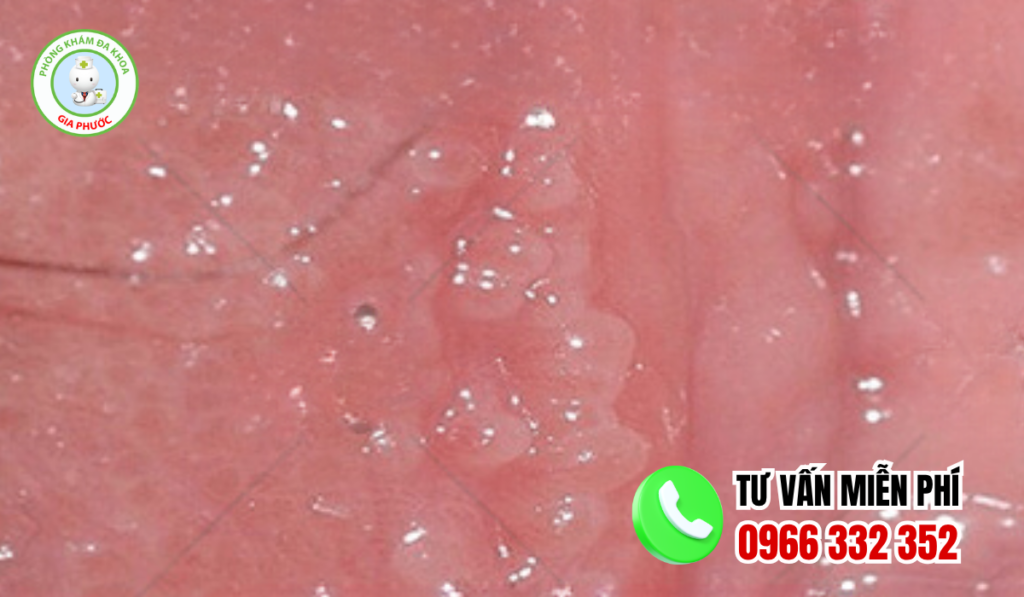 Hình ảnh mụn gai sinh dục nữ