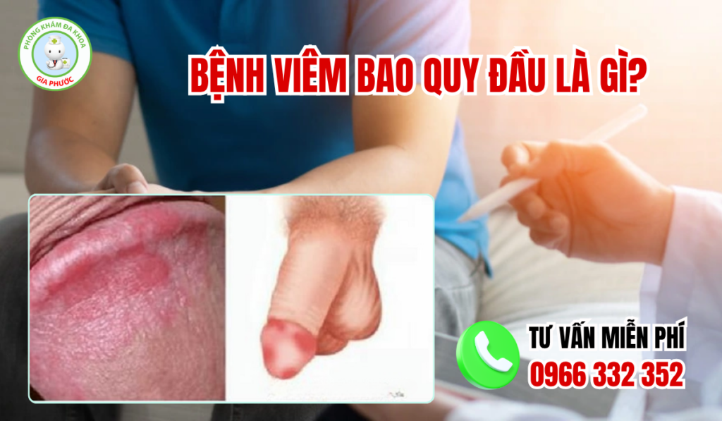 Bệnh viêm bao quy đầu là gì