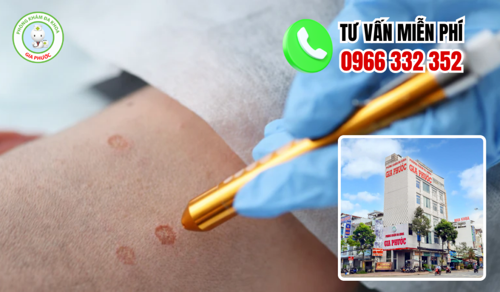 Địa chỉ điều trị sùi mào gà an giang