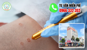 Địa chỉ điều trị sùi mào gà an giang