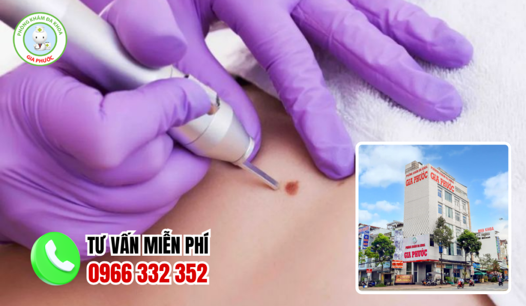 Địa chỉ điều trị sùi mào gà Bạc Liêu