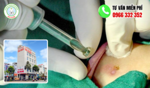 Địa chỉ điều trị sùi mào gà cà mau