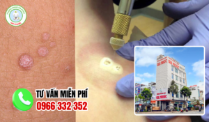 Địa chỉ điều trị sùi mào gà đồng tháp
